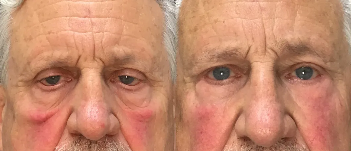Front View Lower Lid Blepharoplasty, cheeklift before and after photo by Dr. Tarbet
