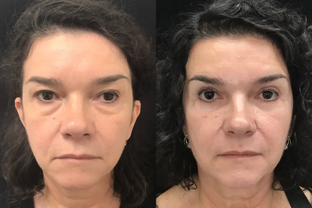 Front View Quad Bleph, Modified Cheeklift, Novathread Browlift before and after photo by Dr. Tarbet