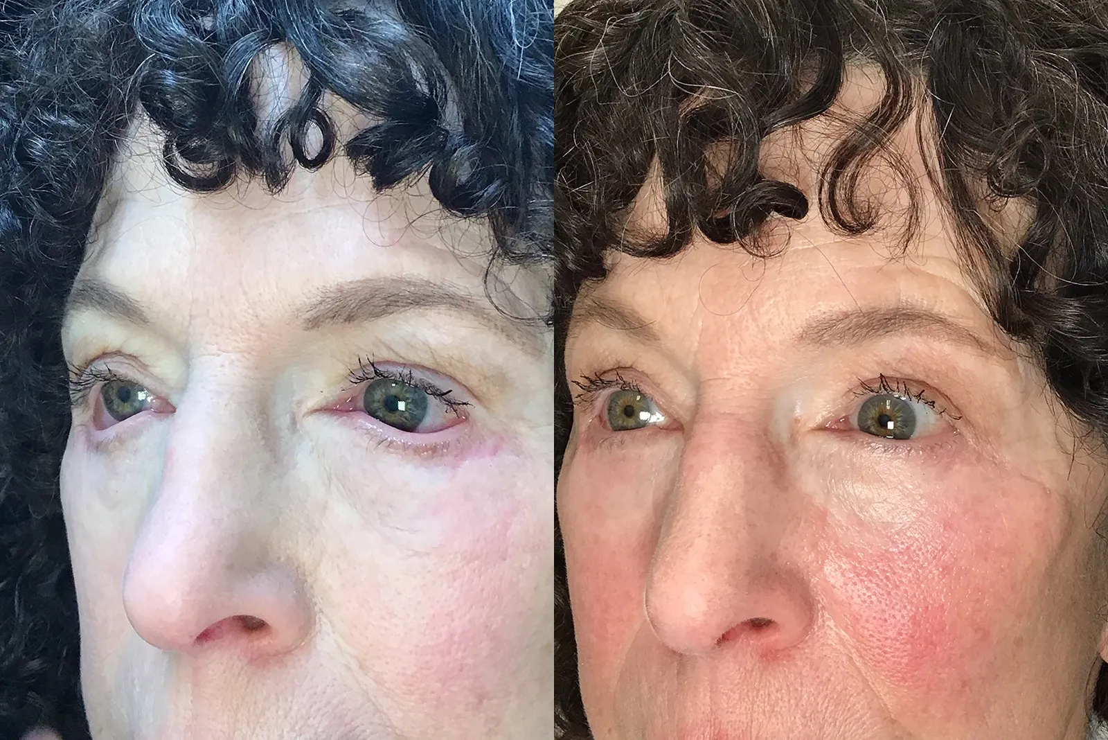 Left Oblique View Conjunctivoplasty, Ectropion repair before and after photo by Dr. Tarbet