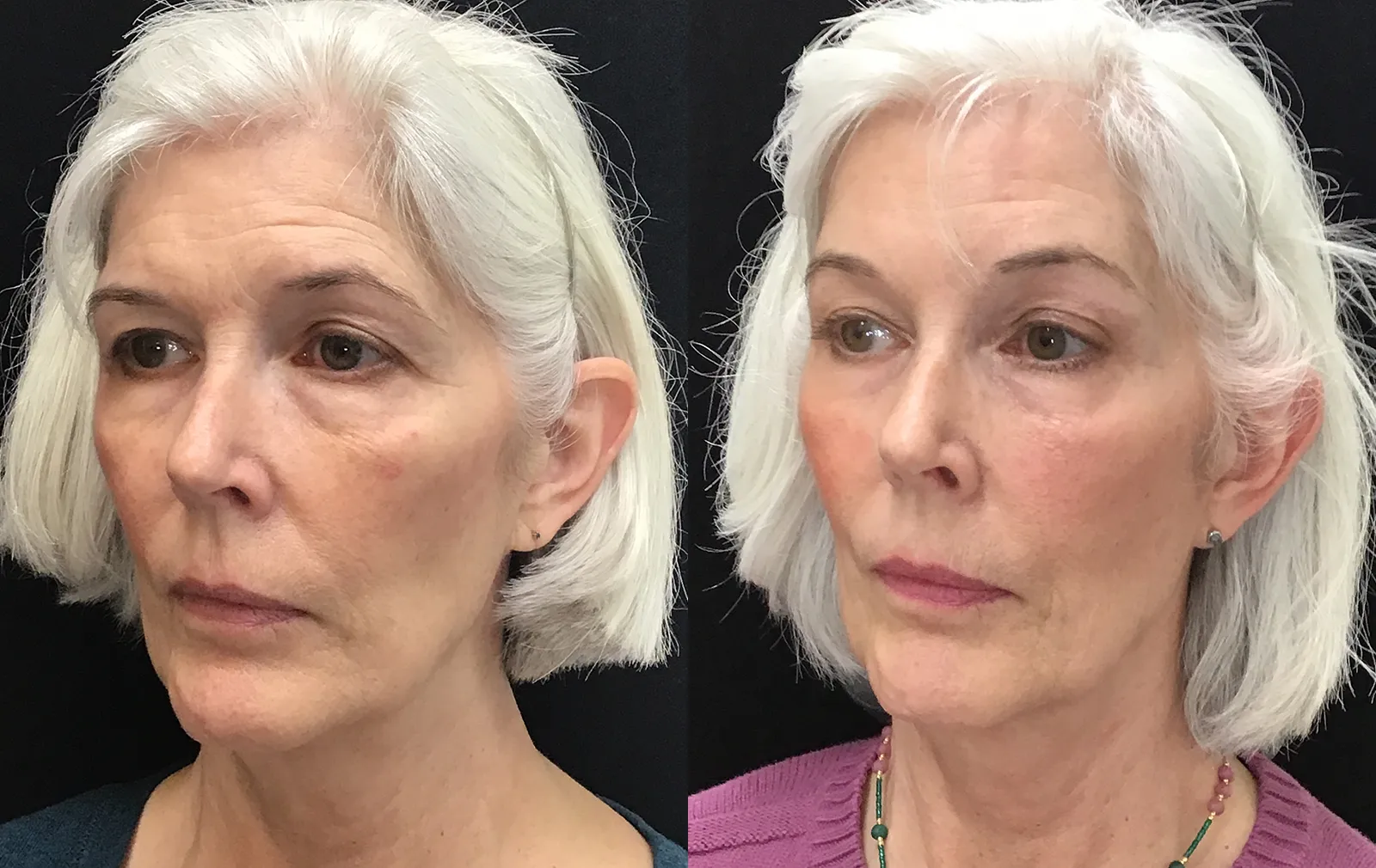 Left Oblique View Endoscopic Browlift before and after photo by Dr. Tarbet