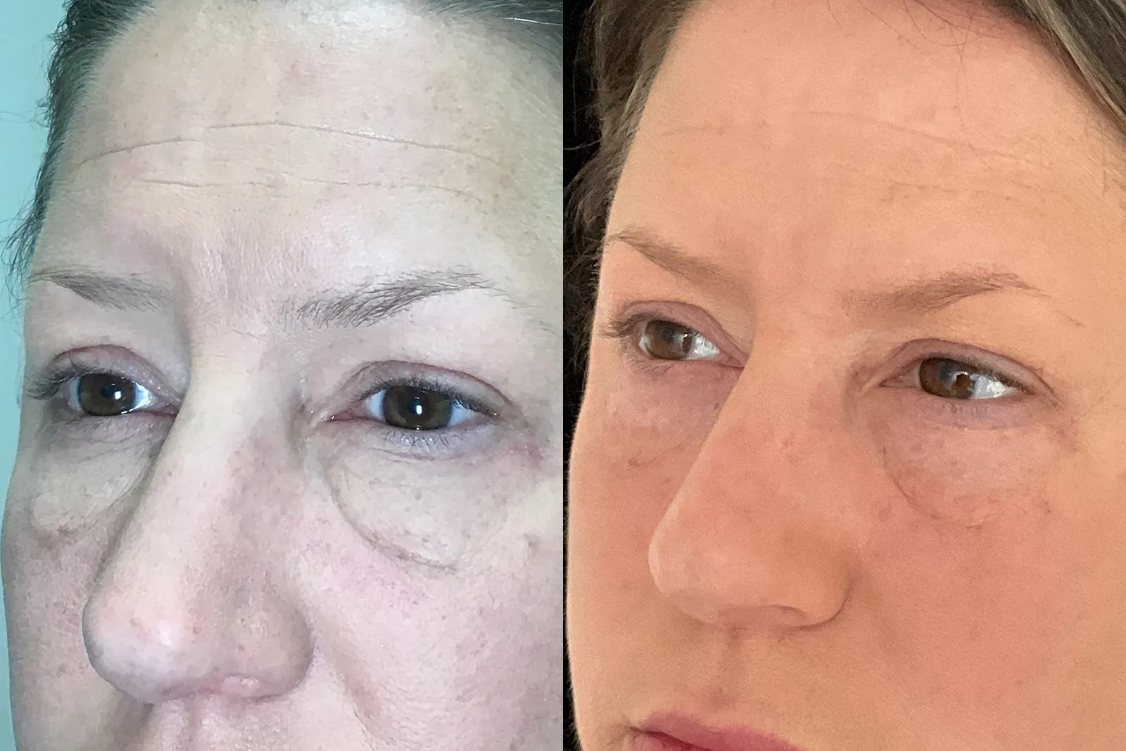 Left Oblique View Lower Blepharoplasty before and after photo by Dr. Tarbet