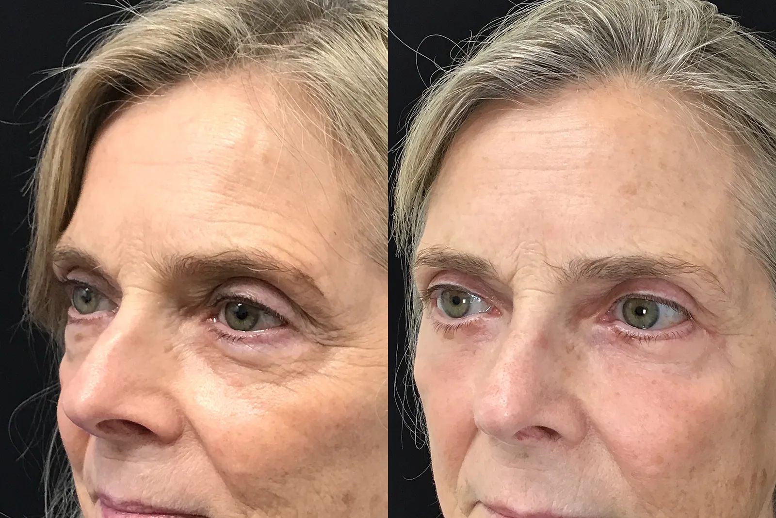 Left Oblique View Lower Blepharoplasty before and after photo by Dr. Tarbet