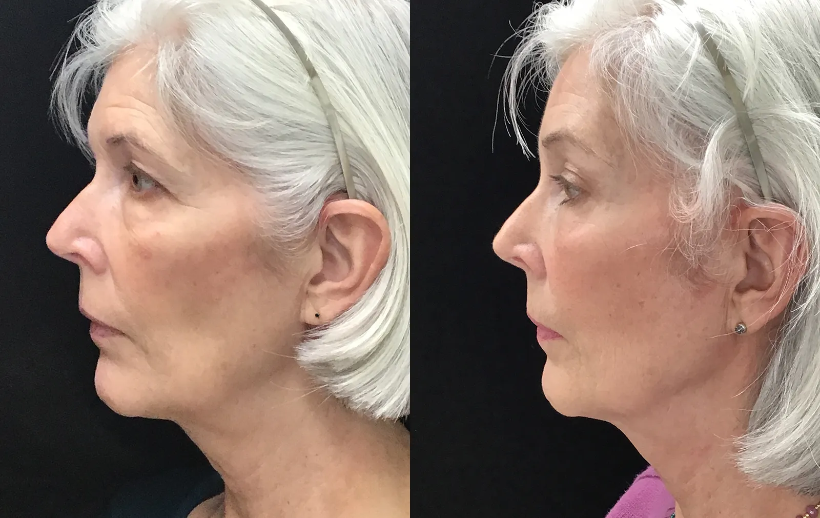 Left Side View Endoscopic Browlift before and after photo by Dr. Tarbet