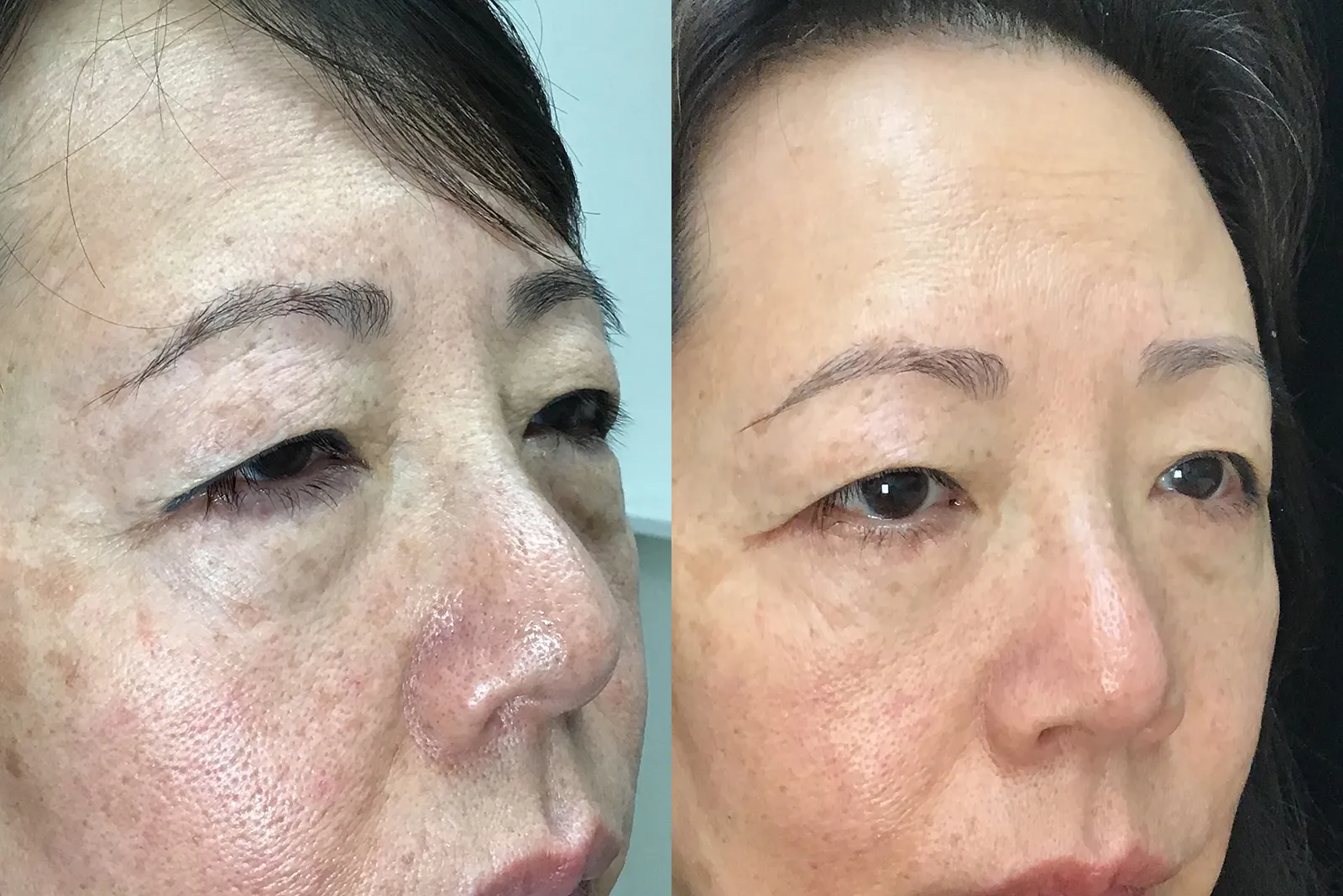 Right Oblique View Conjunctival Myomectomy, Ectropion Repair, Lower Blepharoplasty before and after photo by Dr. Tarbet