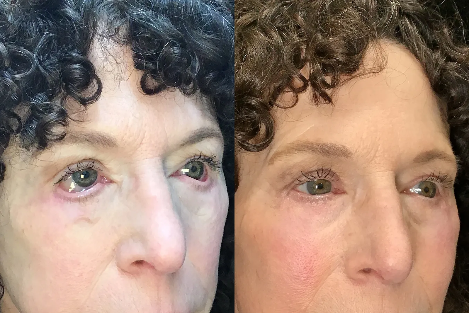 Right Oblique View Conjunctivoplasty, Ectropion repair before and after photo by Dr. Tarbet
