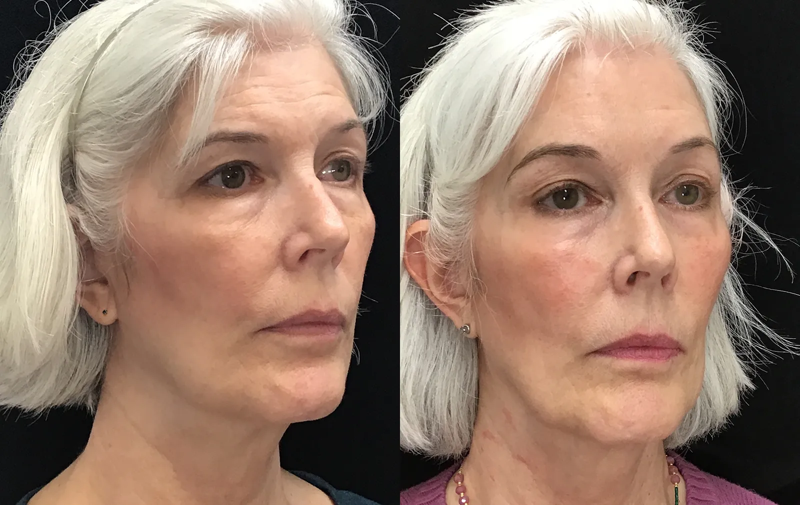 Right Oblique View Endoscopic Browlift before and after photo by Dr. Tarbet