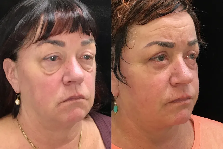 Right Oblique View Facelift, Neck Liposuction, Quad Blepharoplasty, Cheeklift, Ectropion Repair before and after photo by Dr. Tarbet