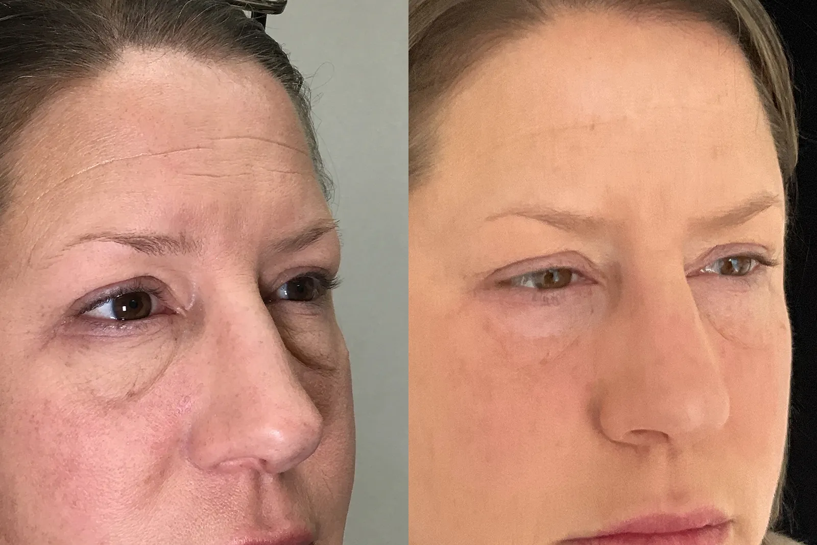 Right Oblique View Lower Blepharoplasty before and after photo by Dr. Tarbet