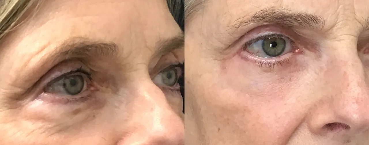 Right Oblique View Lower Blepharoplasty before and after photo by Dr. Tarbet