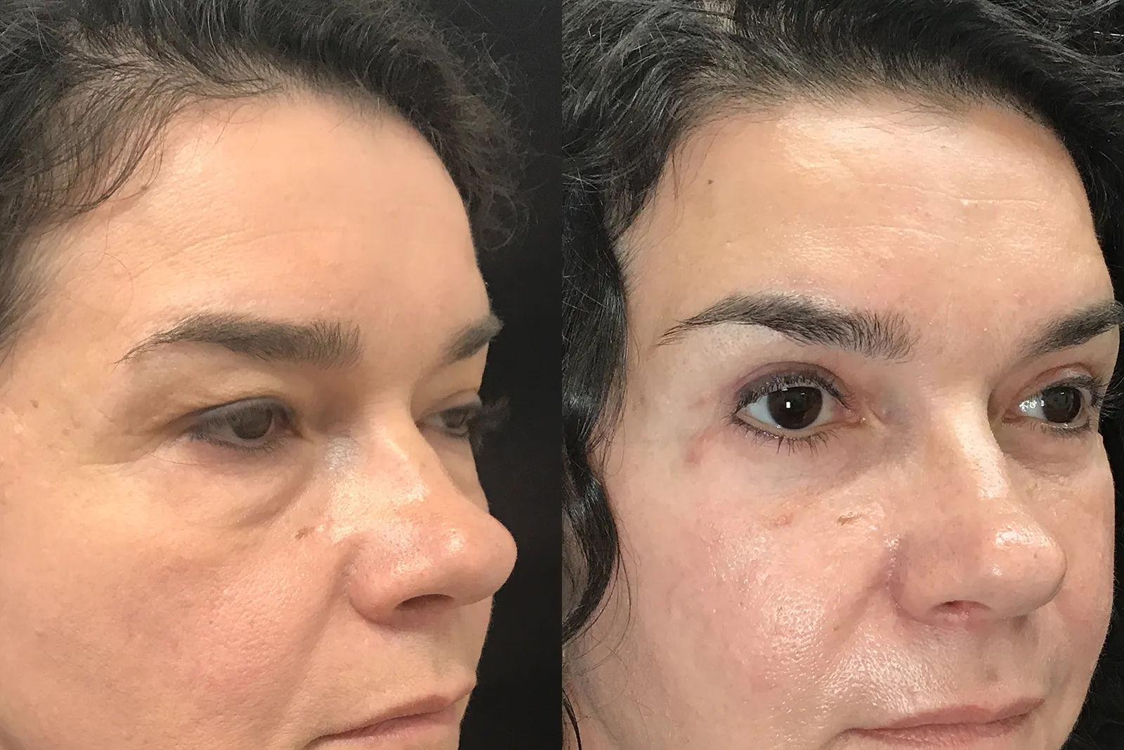 Right Oblique View Quad Bleph, Modified Cheeklift, Novathread Browlift before and after photo by Dr. Tarbet