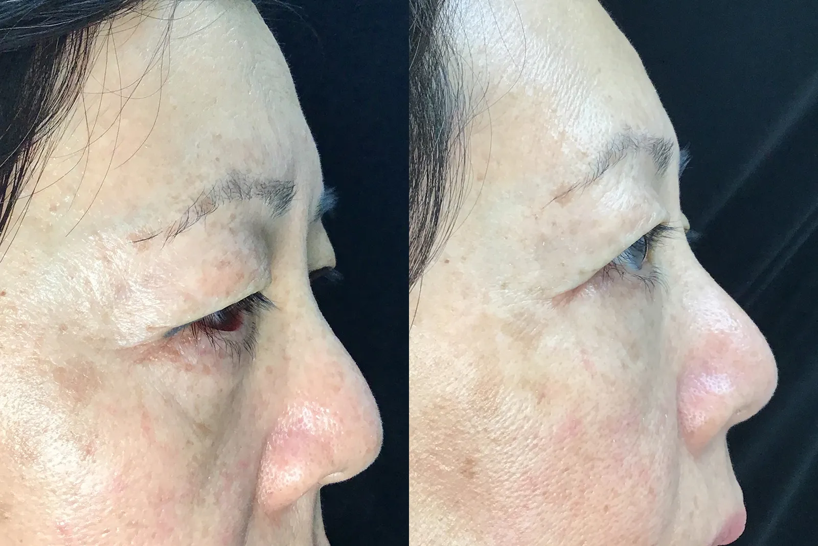 Right Side View Conjunctival Myomectomy, Ectropion Repair, Lower Blepharoplasty before and after photo by Dr. Tarbet
