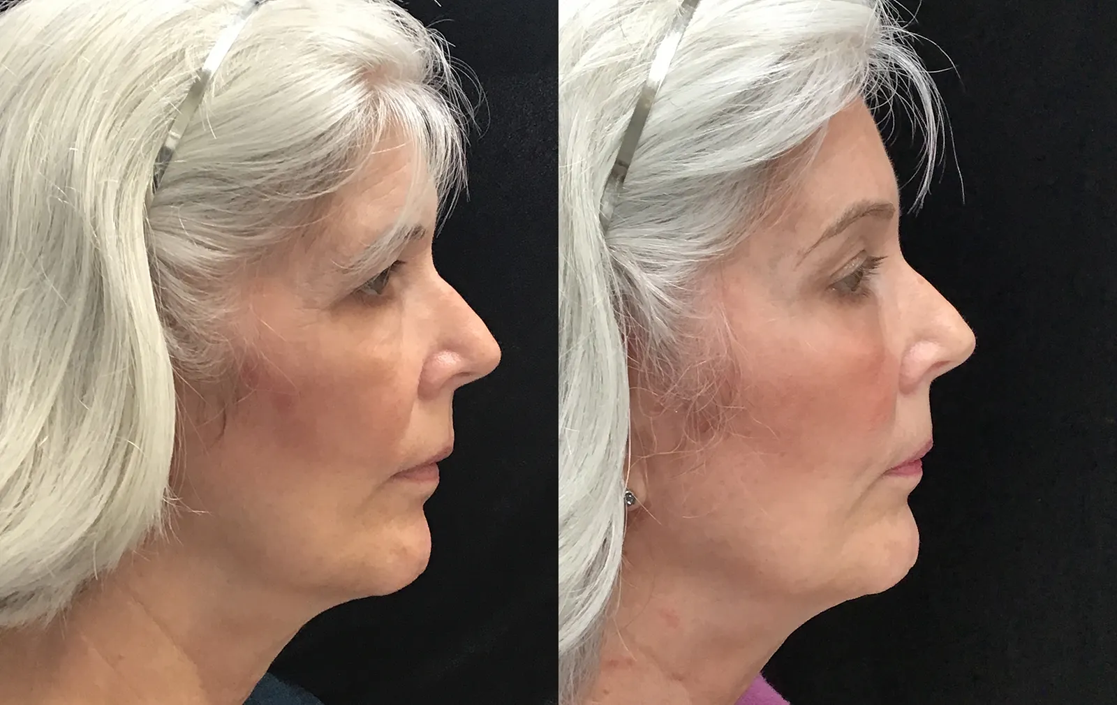 Right Side View Endoscopic Browlift before and after photo by Dr. Tarbet