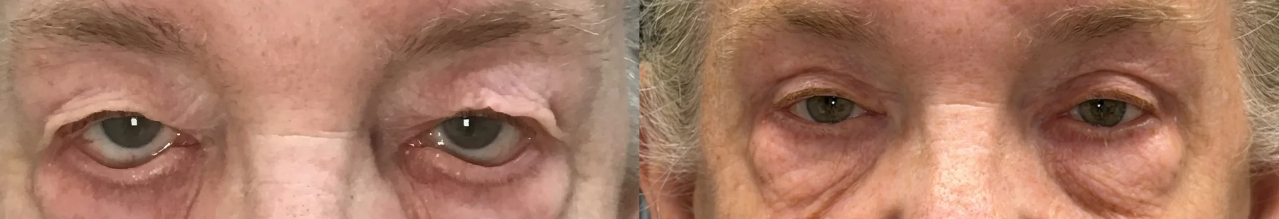 Front View BUL Blepharoplasty, Ectropion Repair before and after photo by Dr. Tarbet