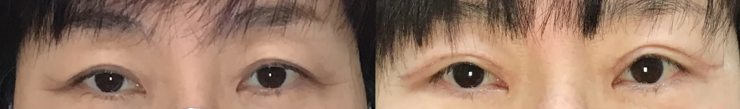 Front View BUL Blepharoplasty before and after photo by Dr. Tarbet
