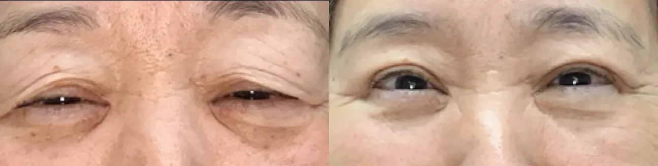 Front View BUL Blepharoplasty before and after photo by Dr. Tarbet