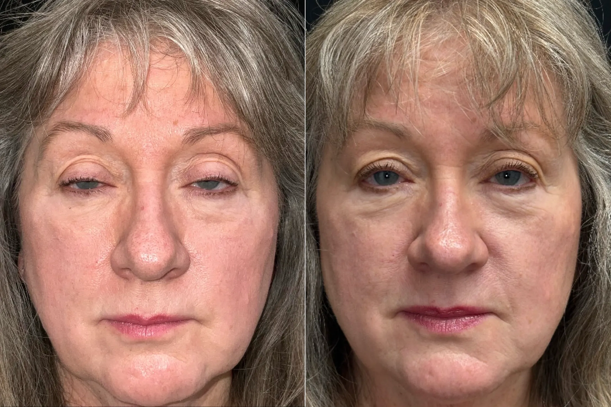 Front View BUL CM before and after photo by Dr. Tarbet
