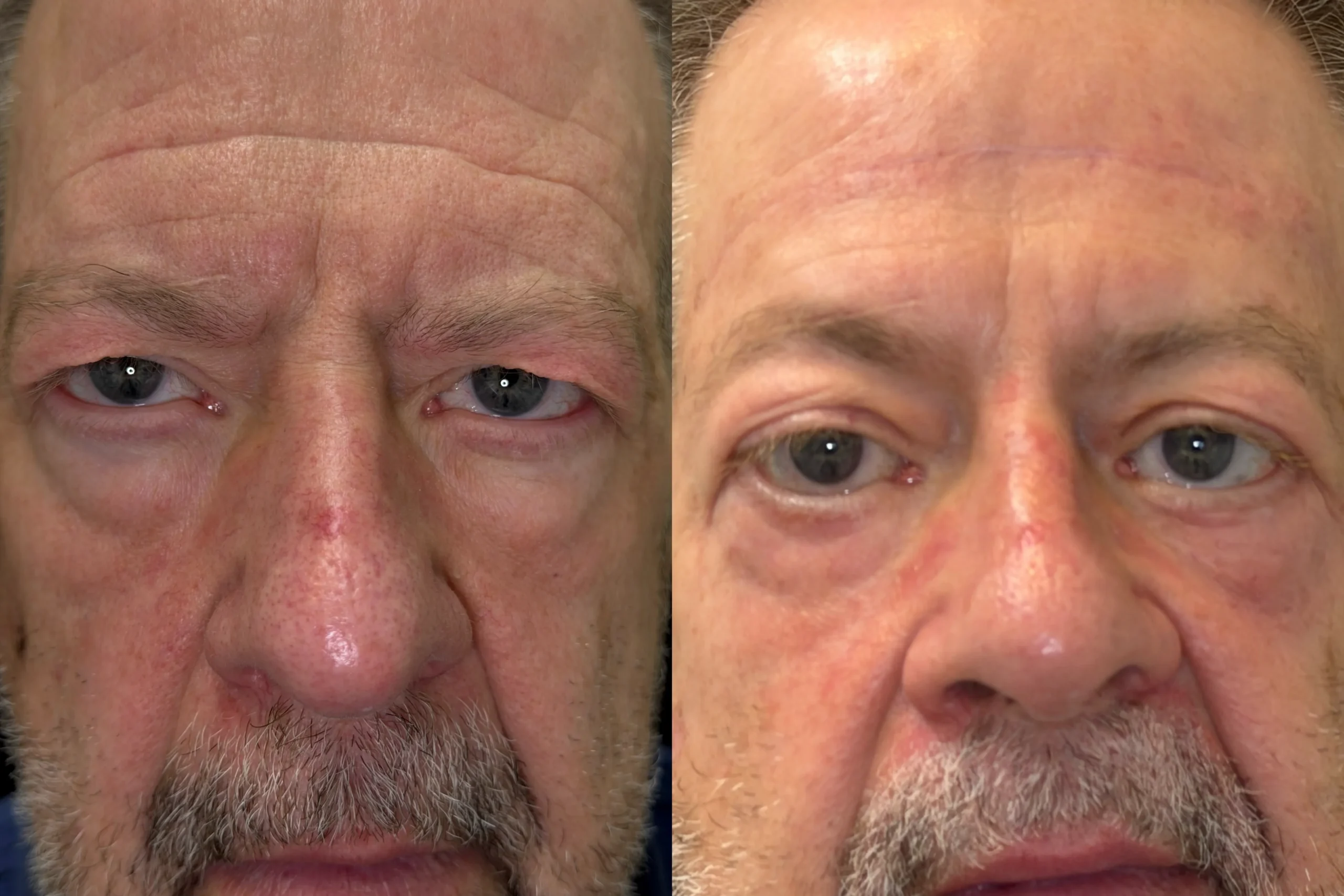 Front View Blepharolasty, Cheek Lift, Ectropion Repair before and after photo by Dr. Tarbet