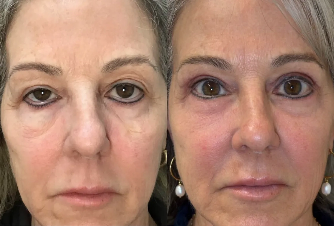 Front View Blepharolasty, EndoBrow, Ectropion Repair before and after photo by Dr. Tarbet