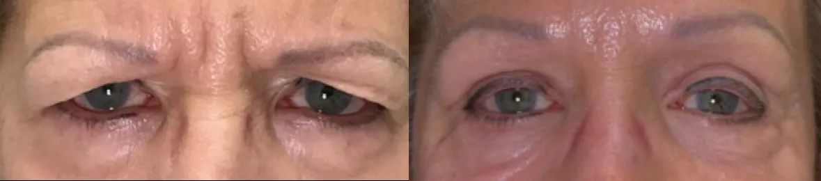 Front View Blepharoplasty, Cheek Lift, Endobrow before and after photo by Dr. Tarbet