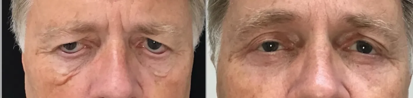 Front View Blepharoplasty, Ectropion Repair, Endobrow before and after photo by Dr. Tarbet
