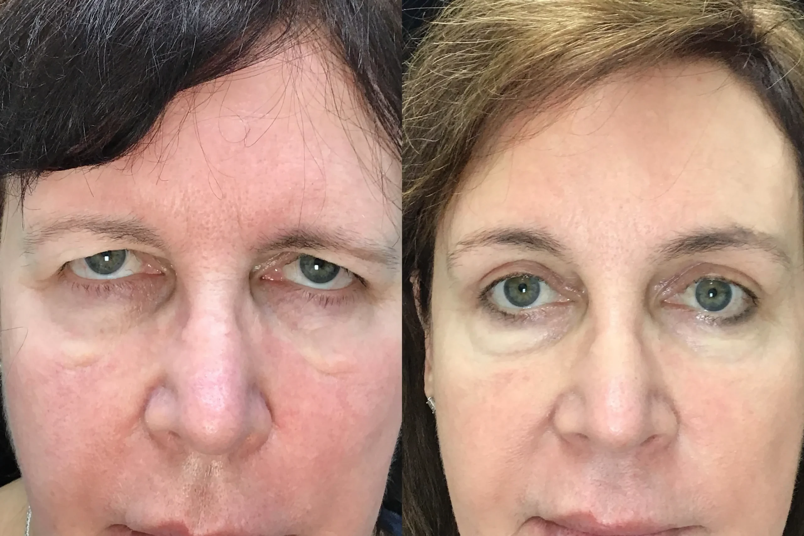 Front View Blepharoplasty, Ectropion Repair, Endobrow before and after photo by Dr. Tarbet