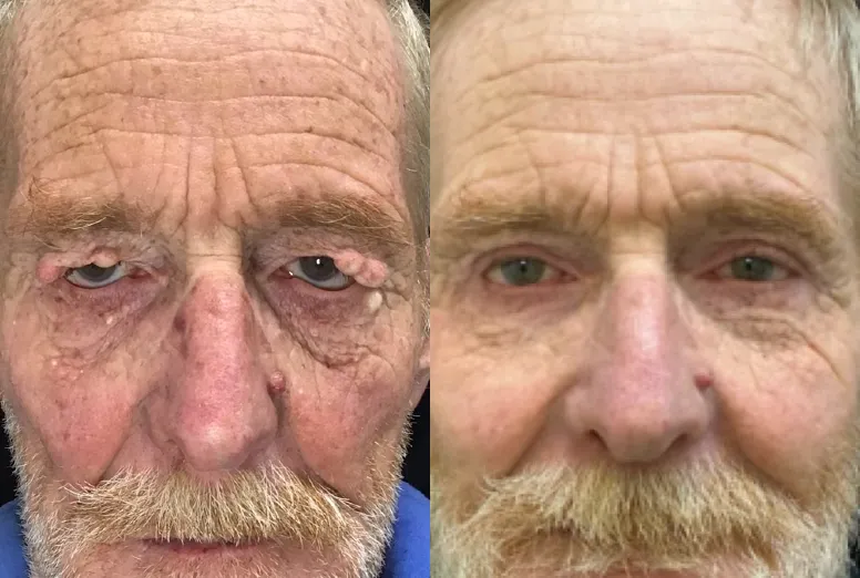 Front View Blepharoplasty, Ectropion Repair before and after photo by Dr. Tarbet