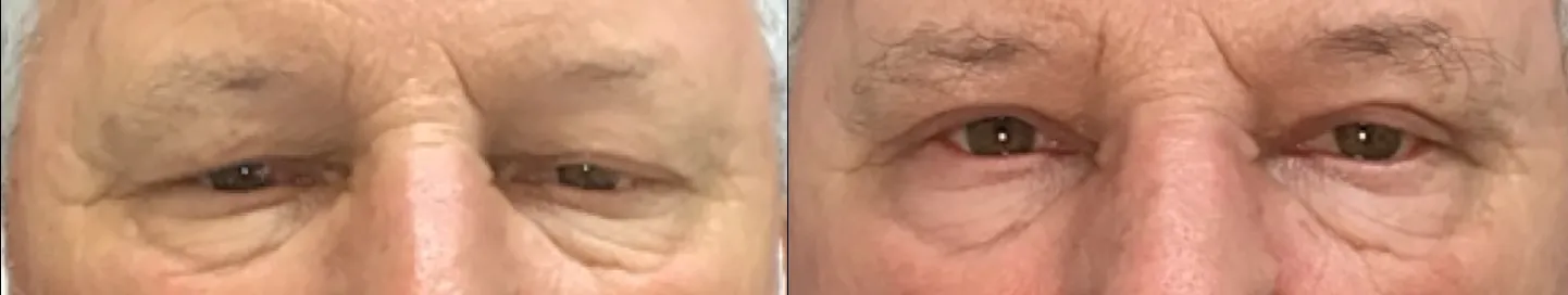 Front View Blepharoplasty, Levator Repair before and after photo by Dr. Tarbet