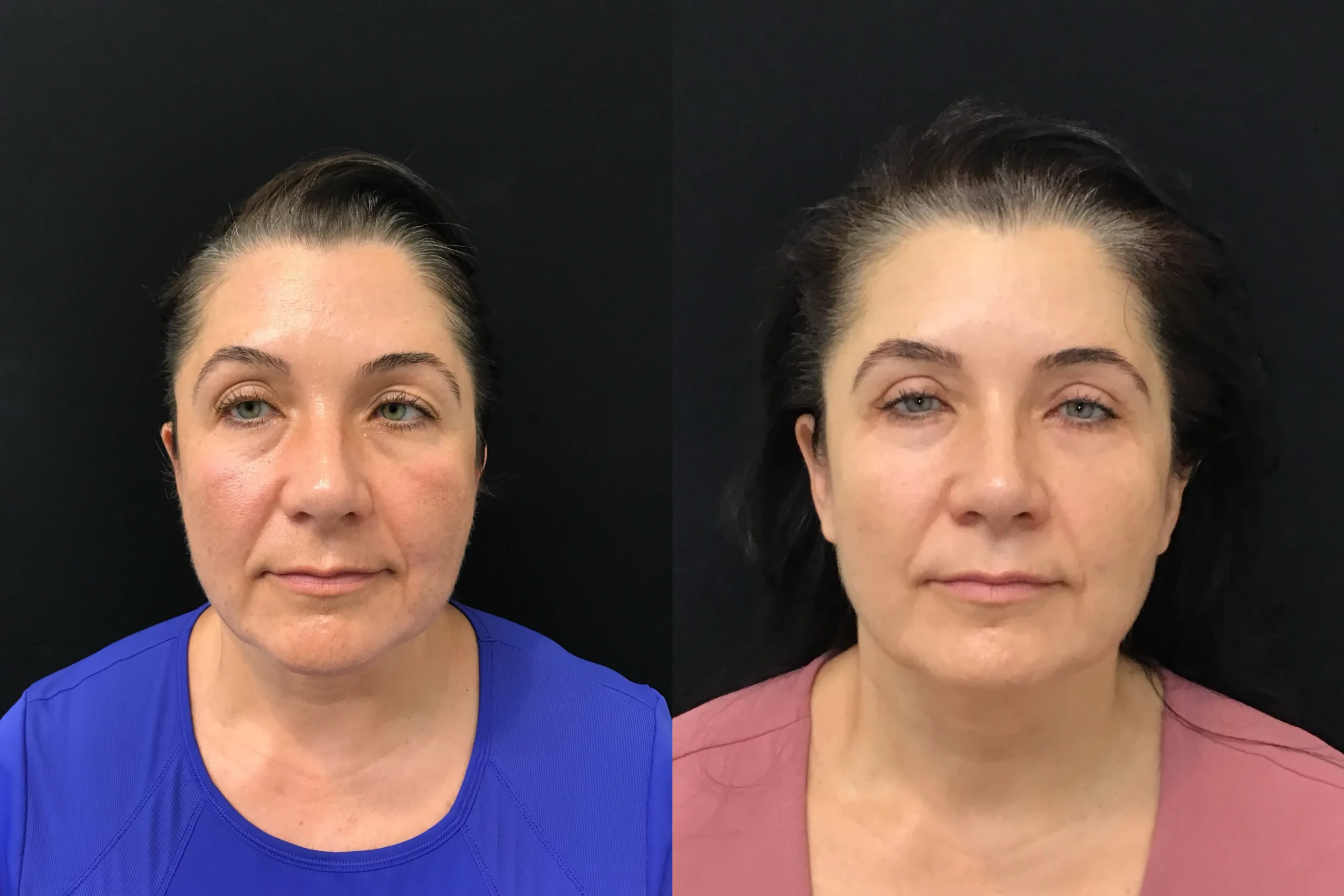 Front View Blepharoplasty, Thread Lift before and after photo by Dr. Tarbet