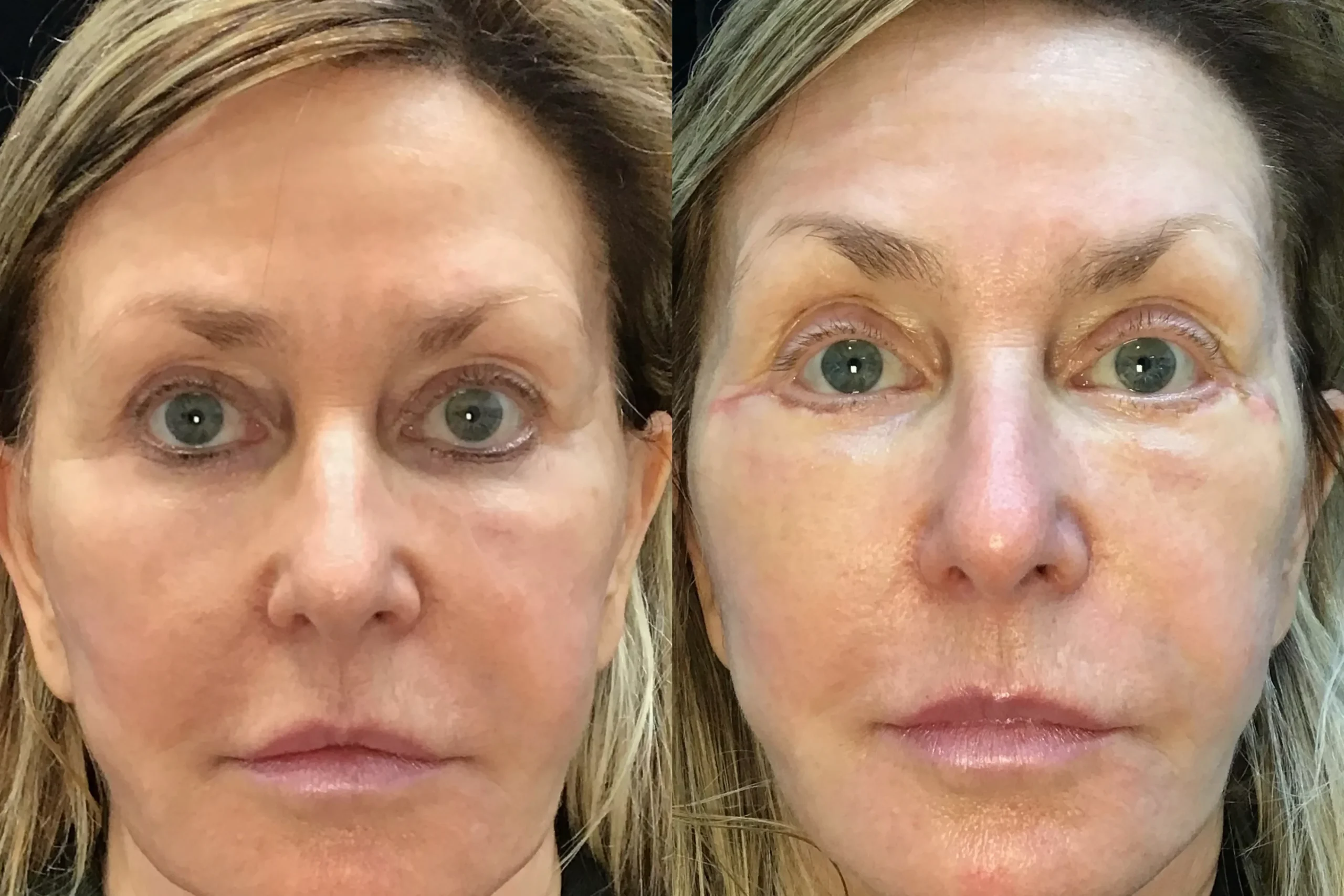 Front View Cheek Lift before and after photo by Dr. Tarbet