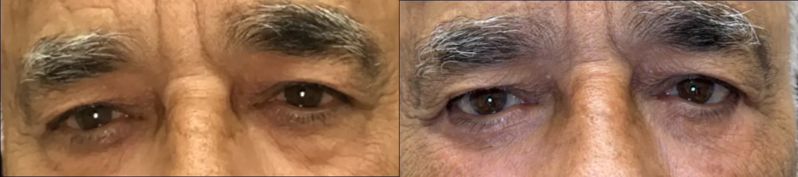 Front View Ectropion Repair, Blepharoplasty, Cheeklift before and after photo by Dr. Tarbet