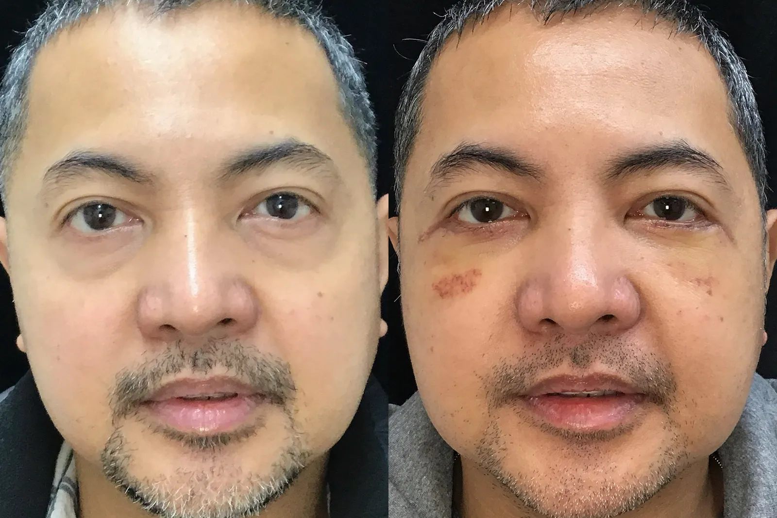 Front View Lower Blepharoplasty, Cheek Lift before and after photo by Dr. Tarbet