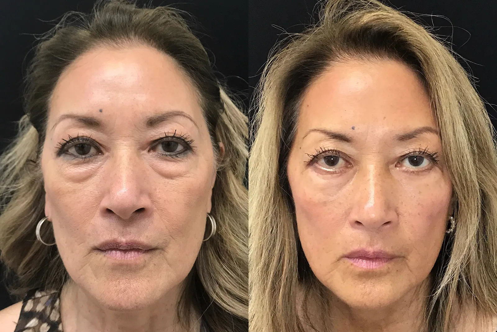 Front View Lower Blepharoplasty before and after photo by Dr. Tarbet