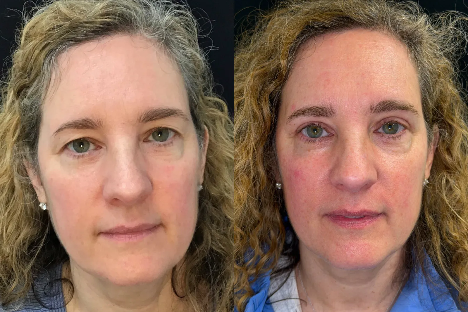 Front View Upper Blepharoplasty, Brow Lift before and after photo by Dr. Tarbet