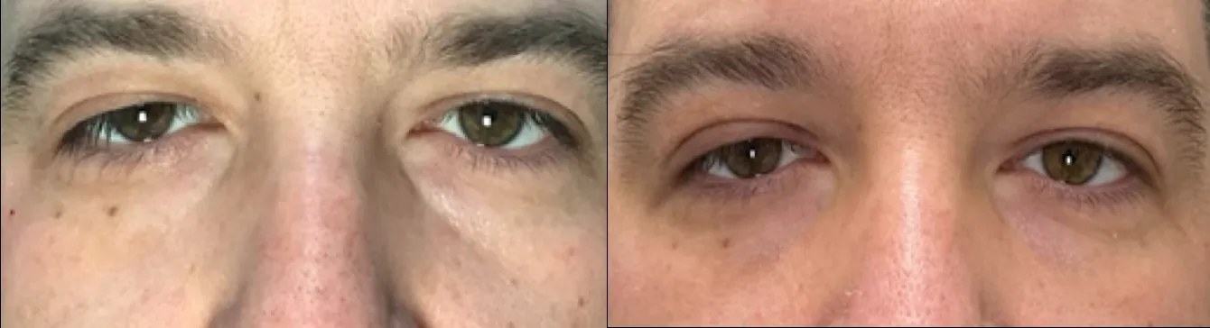 Front View Upper Lid Levator Repair before and after photo by Dr. Tarbet