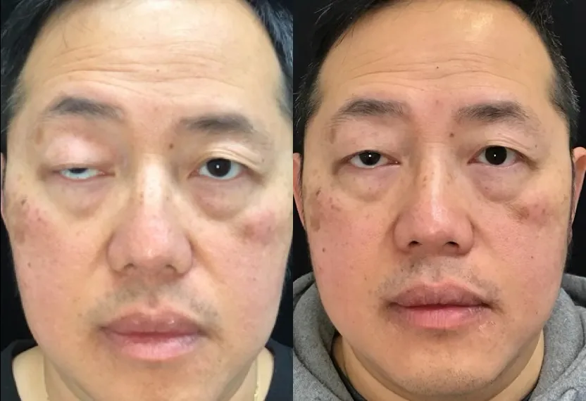 Front View Upper Lid Levator Resection before and after photo by Dr. Tarbet
