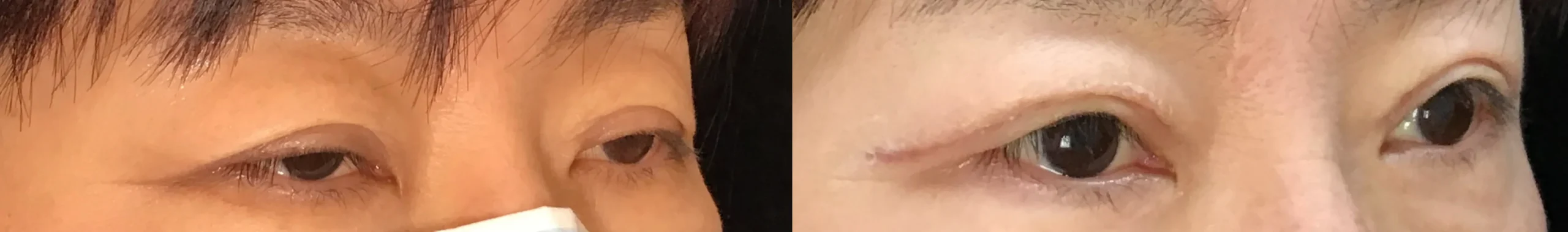 Oblique View BUL Blepharoplasty before and after photo by Dr. Tarbet