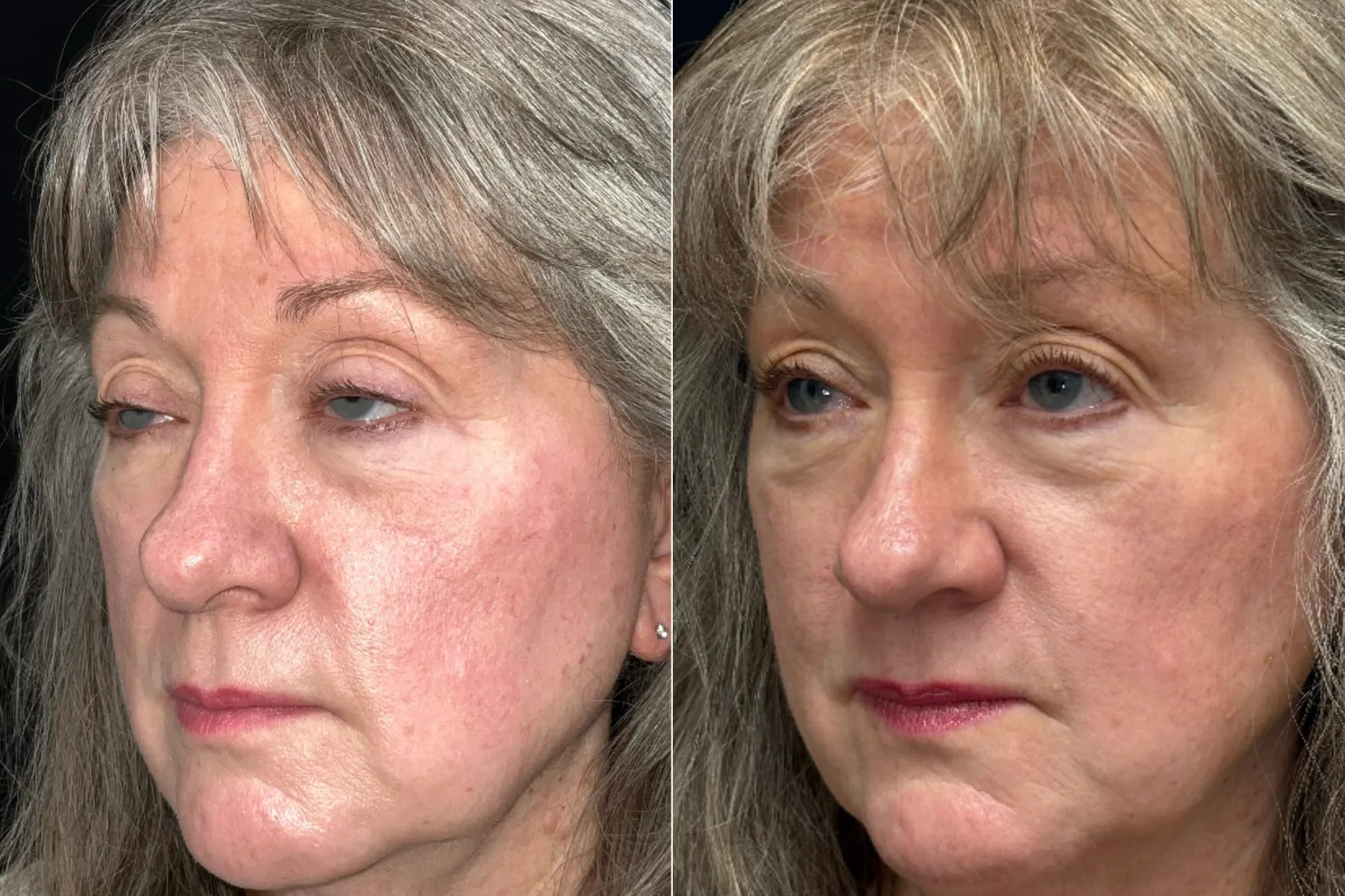 Oblique View BUL CM before and after photo by Dr. Tarbet