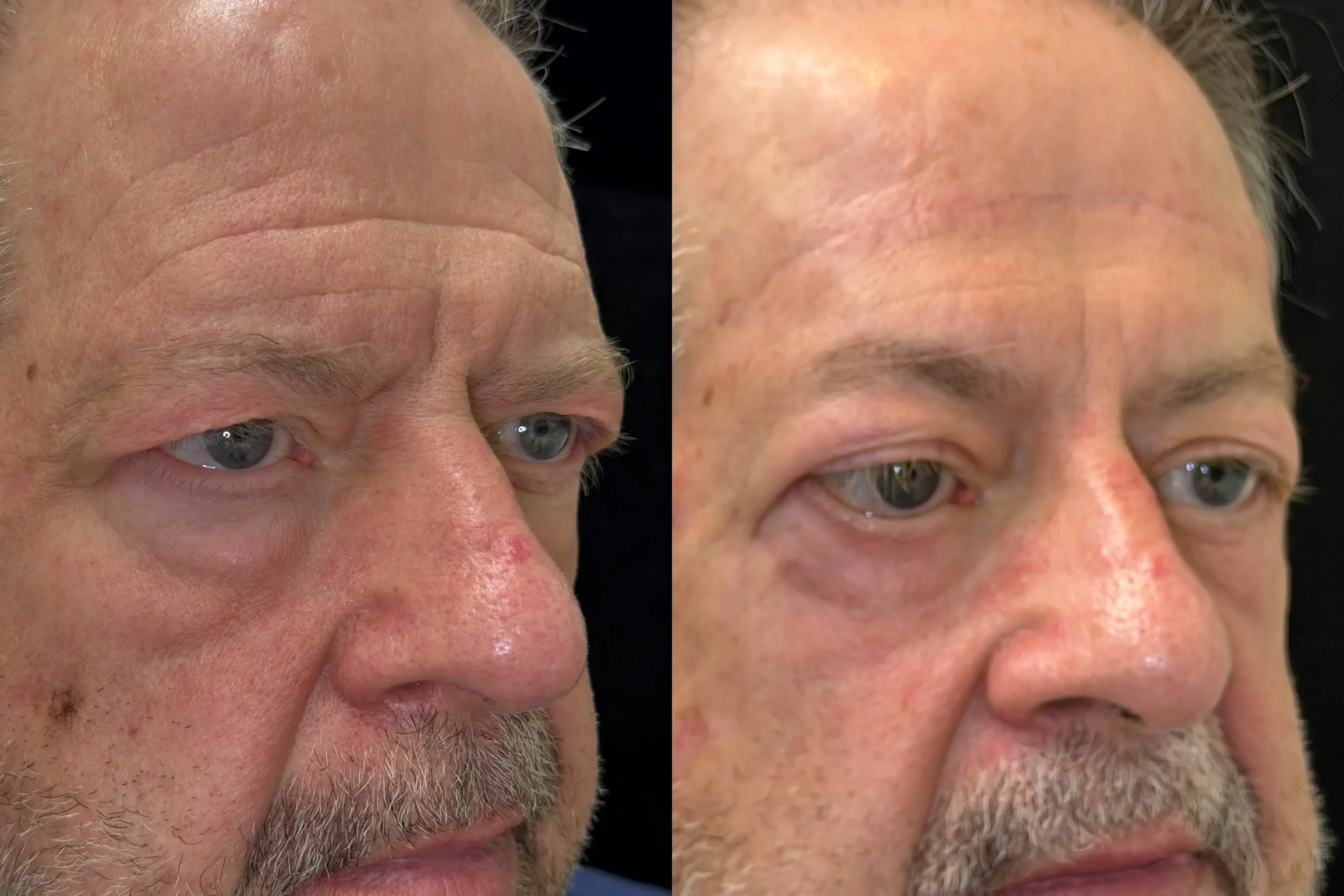 Oblique View Blepharolasty, Cheek Lift, Ectropion Repair before and after photo by Dr. Tarbet