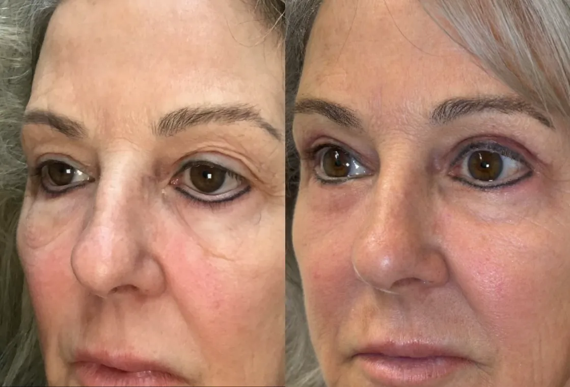 Oblique View Blepharolasty, EndoBrow, Ectropion Repair before and after photo by Dr. Tarbet