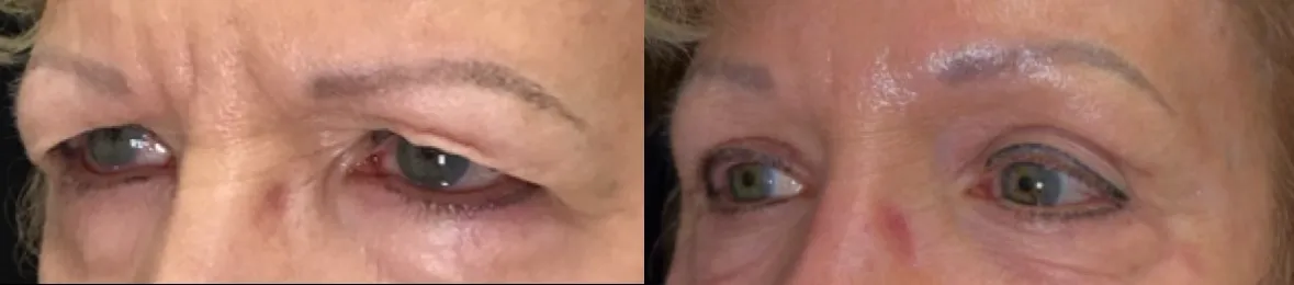 Oblique View Blepharoplasty, Cheek Lift, Endobrow before and after photo by Dr. Tarbet