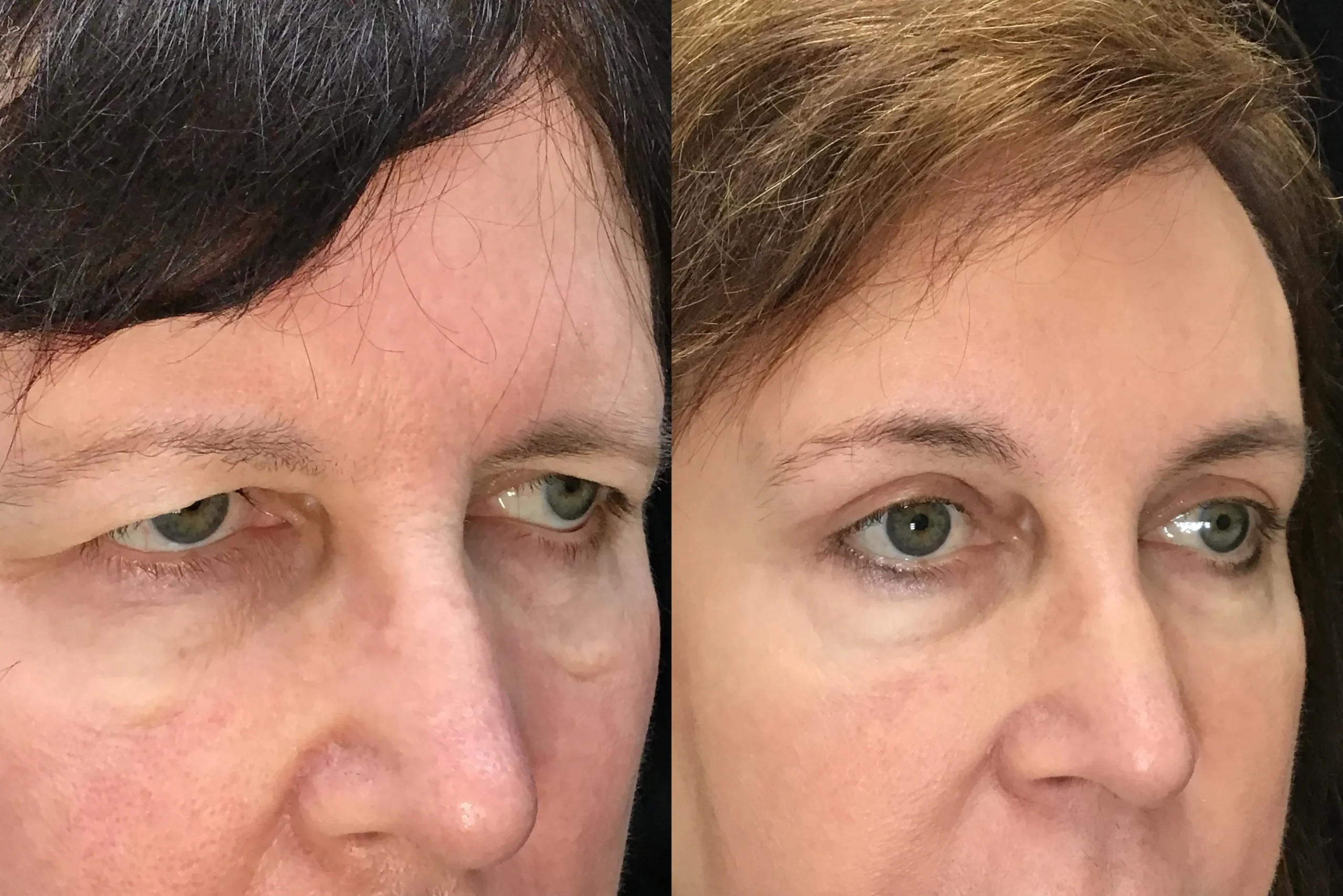 Oblique View Blepharoplasty, Ectropion Repair, Endobrow before and after photo by Dr. Tarbet