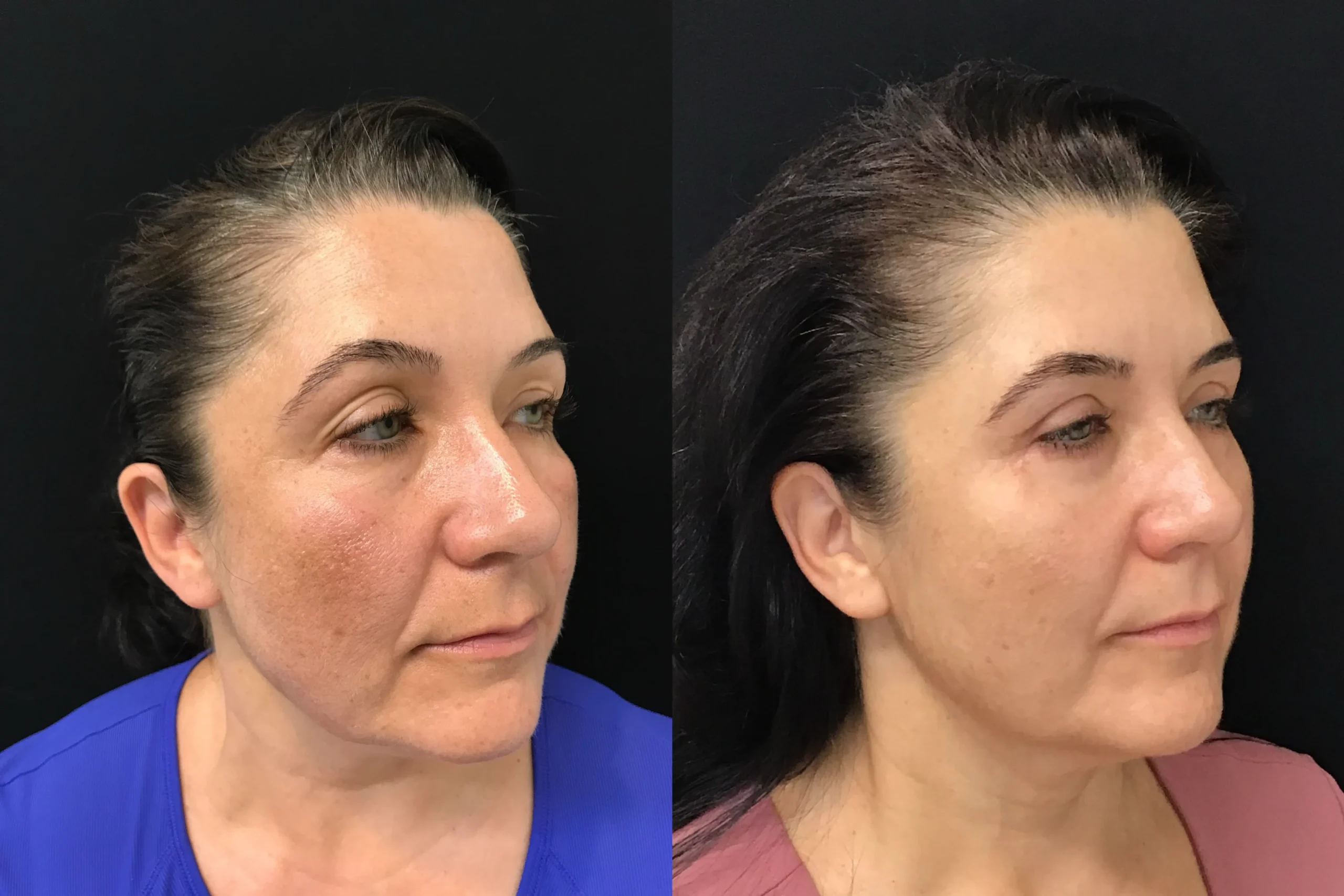 Oblique View Blepharoplasty, Thread Lift before and after photo by Dr. Tarbet