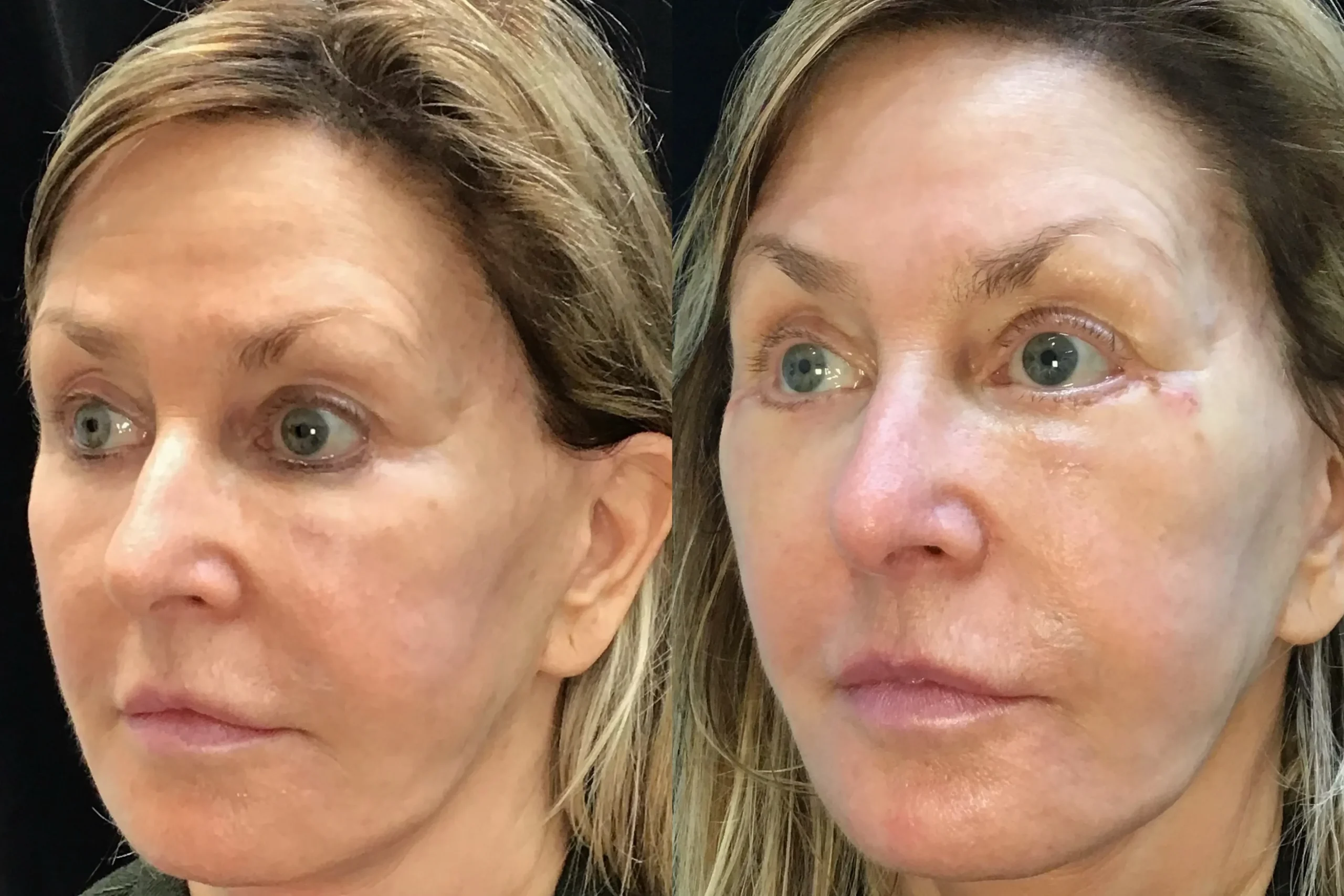 Oblique View Cheek Lift before and after photo by Dr. Tarbet