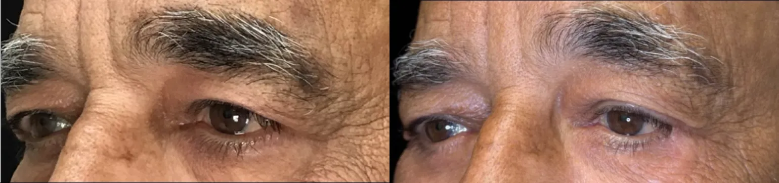 Oblique View Ectropion Repair, Blepharoplasty, Cheeklift before and after photo by Dr. Tarbet