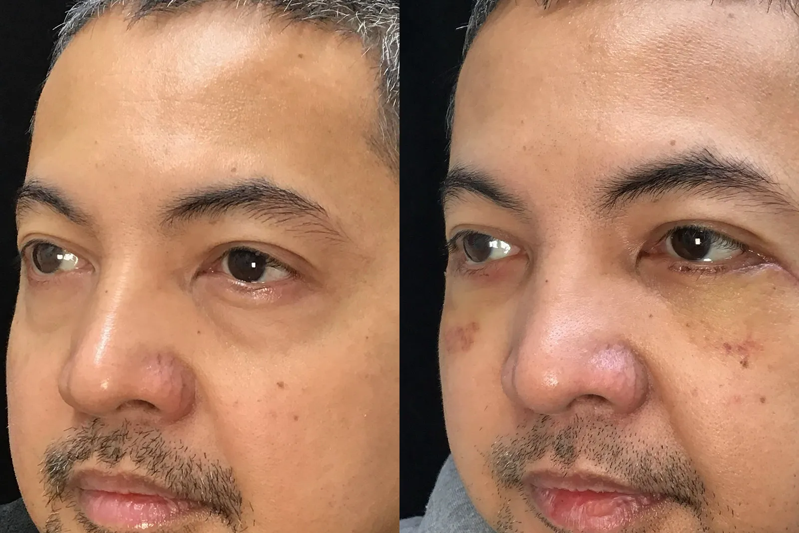 Oblique View Lower Blepharoplasty, Cheek Lift before and after photo by Dr. Tarbet