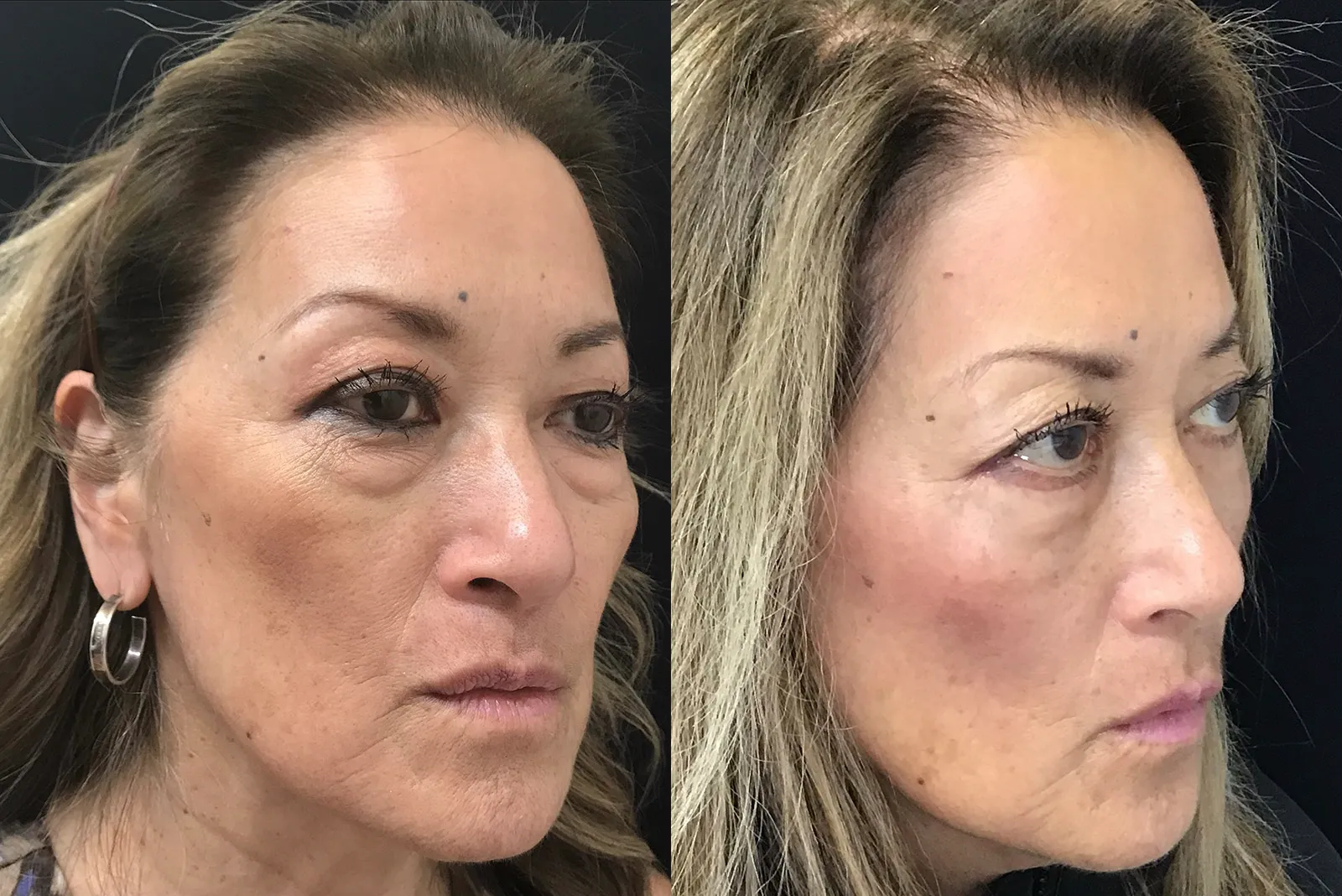 Oblique View Lower Blepharoplasty before and after photo by Dr. Tarbet