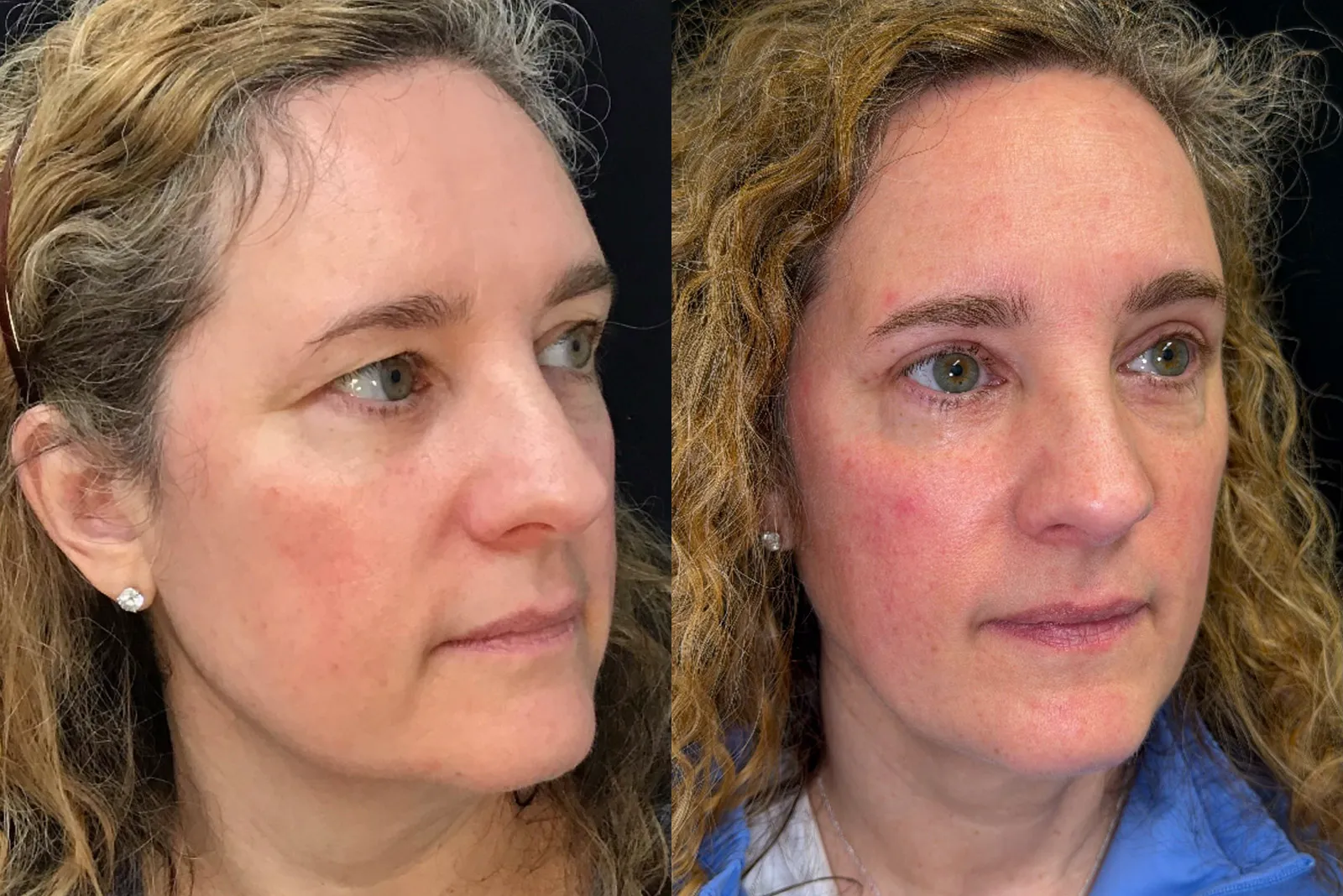 Oblique View Upper Blepharoplasty, Brow Lift before and after photo by Dr. Tarbet