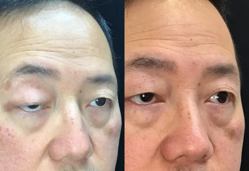Oblique View Upper Lid Levator Resection before and after photo by Dr. Tarbet