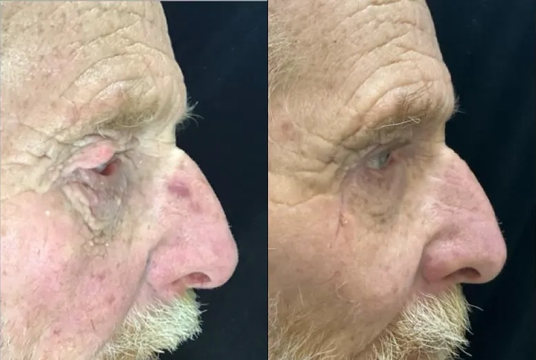 Side View Blepharoplasty, Ectropion Repair before and after photo by Dr. Tarbet